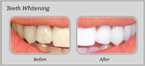 dental education about teeth whitening