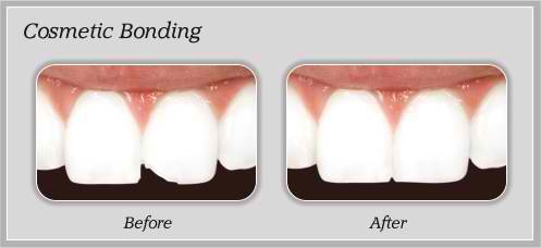 dental education about cosmetic bonding