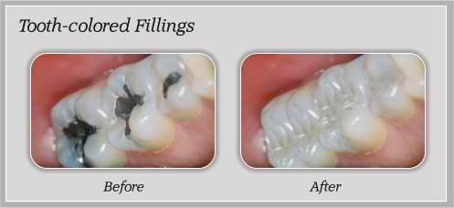 dental education about tooth-colored fillings