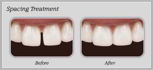 dental education about spacing treatment